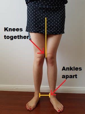 posturedirect|posture direct knee valgus.